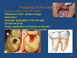 19
Fracture of the tooth
Fracture of the crown of a tooth
Weakened tooth- caries or large
restoration
Improper application of the forceps
Excessive force
proper application of forceps or elevator
will deliver the tooth or Trans alveolar
method
 
