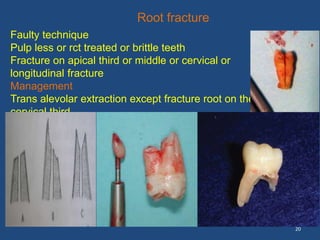 20
Root fracture
Faulty technique
Pulp less or rct treated or brittle teeth
Fracture on apical third or middle or cervical or
longitudinal fracture
Management
Trans alevolar extraction except fracture root on the
cervical third
it can be by close extraction
 