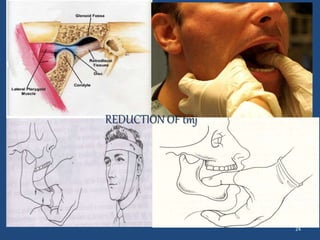 24
REDUCTION OF tmj
 