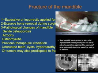 26
Fracture of the mandible
1--Excessive or incorrectly applied force
2-Exsseve bone removal during surgical extraction
3-Pathological changes of mandible
Senile osteoporosis
Atrophy
Osteomyelitis
Previous therapeutic irradiation
Unerupted teeth, cysts, hyperparathyroidism
Or tumors may also predispose to fracture
 