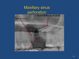 33
Maxillary sinus
perforation
 