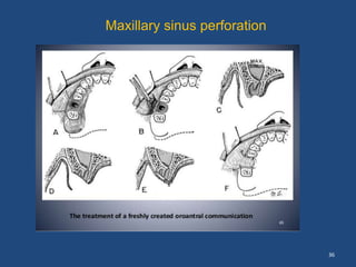 36
Maxillary sinus perforation
 