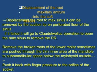 38
---Displacement the root to max sinus it can be
removed by the suction tip on perforated floor of the
sinus
if it failed it will go to Claudelwelluc operation to open
the max sinus to remove the RR,
Remove the broken roots of the lower molar sometimes
are pushed through the thin inner area of the mandible
to submandibular space below the mylohyoid muscle---
--
Push it back with finger pressure to the orifice of the
socket
Displacement of the root
- maxillary antrum
- -into the soft
tissues
 