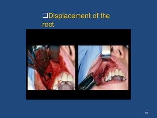40
Displacement of the
root
- maxillary
antrum
 