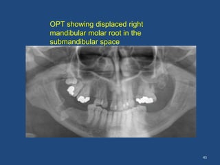 43
OPT showing displaced right
mandibular molar root in the
submandibular space
 