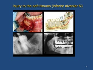 45
Injury to the soft tissues (inferior alveolar N)
 