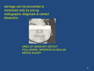 48
AREA OF SENSORY DEFICIT
FOLLOWING INFERIOR ALVEOLAR
NERVE INJURY
damage can be prevented or
minimized only by pre-op
radiographic diagnosis & careful
dissection.
 