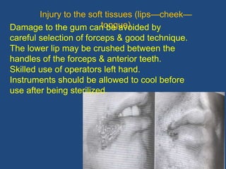 51
Injury to the soft tissues (lips—cheek—
tongue)Damage to the gum can be avoided by
careful selection of forceps & good technique.
The lower lip may be crushed between the
handles of the forceps & anterior teeth.
Skilled use of operators left hand.
Instruments should be allowed to cool before
use after being sterilized.
 