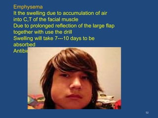 52
Emphysema
It the swelling due to accumulation of air
into C,T of the facial muscle
Due to prolonged reflection of the large flap
together with use the drill
Swelling will take 7---10 days to be
absorbed
Antibiotic is recommended
 