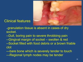 66
--granulation tissue is absent in cases of dry
socket.
--Dull, boring pain to severe throbbing pain
--Gingival margin of socket – swollen & red
--Socket filled with food debris or a brown friable
clot
---bare bone which is severely tender to touch
---Regional lymph nodes may be tender
Clinical features
 