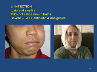 69
b. INFECTION :-
pain and swelling
Mild- hot saline mouth baths
Severe – I & D, antibiotic & analgesics
 