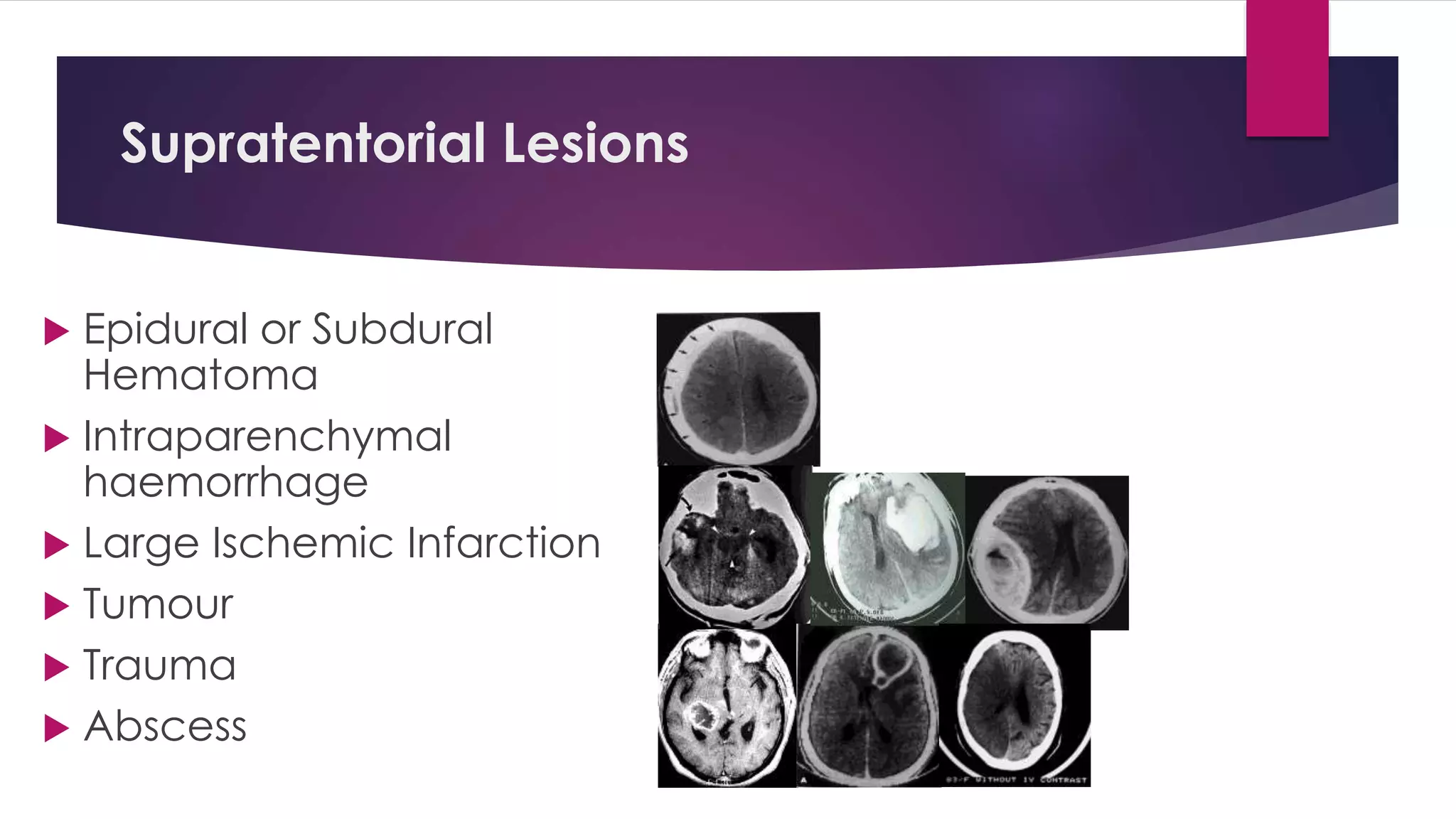 Supratentorial Lesions
 Epidural or Subdural
Hematoma
 Intraparenchymal
haemorrhage
 Large Ischemic Infarction
 Tumour
 Trauma
 Abscess
 