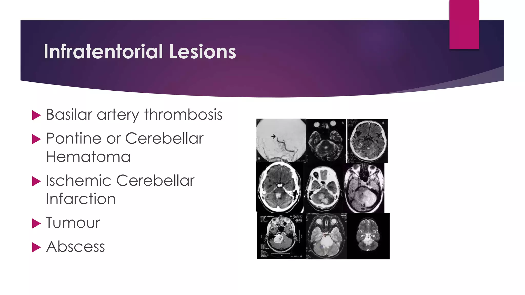 Infratentorial Lesions
 Basilar artery thrombosis
 Pontine or Cerebellar
Hematoma
 Ischemic Cerebellar
Infarction
 Tumour
 Abscess
 