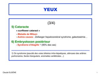 YEUX
(3/4)
5) Cataracte 
« sunflower cataract »  
- Maladie de Wilson
- Autres causes : Zellweger hepatocerebral syndrome,...