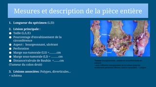 Mesures et description de la pièce entière
1. Longueur du spécimen (L/D)
2. Lésion principale :
● Taille (L/L/E)
● Pourcentage d’envahissement de la
circonférence
● Aspect : bourgeonnant, ulcérant
● Perforation
● Marge sus-tumorale (LS) =………cm
● Marge sous-tumorale (LI) = ………cm
● Distance/valvule de Bauhin =........cm
(Tumeur du colon droit)
3. Lésions associées: Polypes, diverticules...
+ schéma
Tumeur bourgeonnante, ulcérée et circonférentielle du
caecum
- avec infiltration transpariétale de la tumeur jusqu’au
revêtement péritonéal (flèche) Lésions associées : 1 polype ;
 