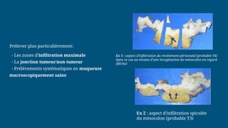 Prélever plus particulièrement:
- Les zones d’infiltration maximale
- La jonction tumeur/non tumeur
- Prélèvements systématiques en muqueuse
macroscopiquement saine
Ex 1 : aspect d’infiltration du revêtement péritonéal (probable T4)
dans ce cas au niveau d’une invagination du mésocolon en regard
(flèche)
Ex 2 : aspect d’infiltration spiculée
du mésocolon (probable T3)
 