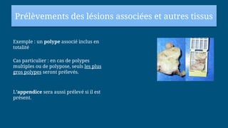 Prélèvements des lésions associées et autres tissus
Exemple : un polype associé inclus en
totalité
Cas particulier : en cas de polypes
multiples ou de polypose, seuls les plus
gros polypes seront prélevés.
L’appendice sera aussi prélevé si il est
présent.
 