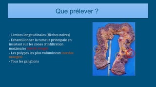 Que prélever ?
- Limites longitudinales (flèches noires)
- Échantillonner la tumeur principale en
insistant sur les zones d’infiltration
maximales (cercle rouge)
- Les polypes les plus volumineux (cercles
oranges)
- Tous les ganglions
 