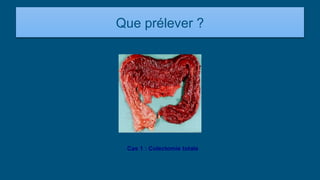 Que prélever ?
Cas 1 : Colectomie totale
 