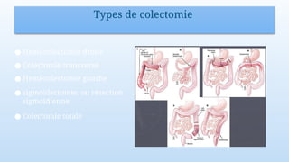 Types de colectomie
● Hemi-colectomie droite
● Colectomie transverse
● Hemi-colectomie gauche
● sigmoïdectomie, ou résection
sigmoïdienne
● Colectomie totale
 