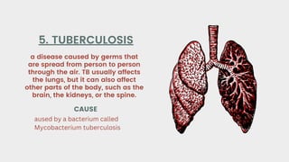 a disease caused by germs that
are spread from person to person
through the air. TB usually affects
the lungs, but it can also affect
other parts of the body, such as the
brain, the kidneys, or the spine.
5. TUBERCULOSIS
CAUSE
aused by a bacterium called
Mycobacterium tuberculosis
 