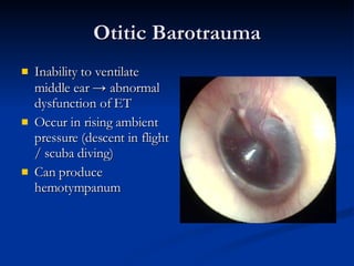 Otitic Barotrauma Inability to ventilate middle ear  ->  abnormal dysfunction of ET Occur in rising ambient pressure (descent in flight / scuba diving) Can produce hemotympanum 