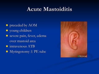 Acute Mastoiditis preceded by AOM young children severe pain, fever, edema over mastoid area intravenous ATB Myringotomy ± PE tube 