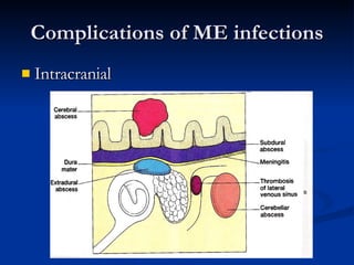 Complications of ME infections Intracranial 