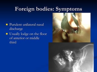 Foreign bodies: Symptoms Purulent unilateral nasal discharge Usually lodge on the floor of anterior or middle third 