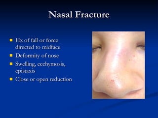 Nasal Fracture Hx of fall or force directed to midface Deformity of nose Swelling, ecchymosis, epistaxis Close or open reduction 