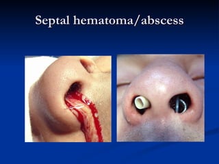 Septal hematoma/abscess 