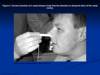 Copyright ©2005 BMJ Publishing Group Ltd. Pope, L E R et al. Postgrad Med J 2005;81:309-314 Figure 2  Correct insertion of a nasal tampon (note that the direction is along the floor of the nasal cavity). 