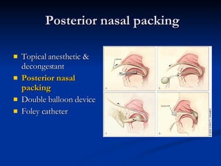 Posterior nasal packing Topical anesthetic & decongestant Posterior nasal packing   Double balloon device Foley catheter 