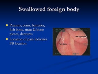 Swallowed foreign body Peanuts, coins, batteries, fish bone, meat & bone pieces, dentures Location of pain indicates FB location 