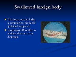 Swallowed foreign body Fish bones tend to lodge in oropharynx, produced ipsilateral symptoms Esophagus FB localize in midline: dramatic acute dysphagia  
