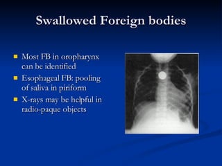 Swallowed Foreign bodies Most FB in oropharynx can be identified Esophageal FB: pooling of saliva in piriform X-rays may be helpful in radio-paque objects 