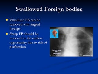 Swallowed Foreign bodies Visualized FB can be removed with angled forceps Sharp FB should be removed at the earliest opportunity due to risk of perforation 