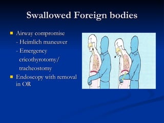 Swallowed Foreign bodies Airway compromise - Heimlich maneuver - Emergency cricothyrotomy/  tracheostomy Endoscopy with removal in OR 