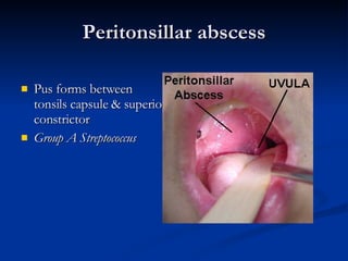 Peritonsillar abscess Pus forms between tonsils capsule & superior constrictor Group A Streptococcus 