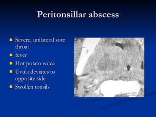 Peritonsillar abscess Severe, unilateral sore throat fever Hot potato voice Uvula deviates to opposite side Swollen tonsils 