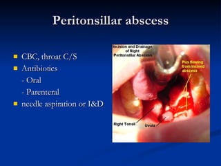 Peritonsillar abscess CBC, throat C/S Antibiotics  - Oral  - Parenteral  needle aspiration or I&D 