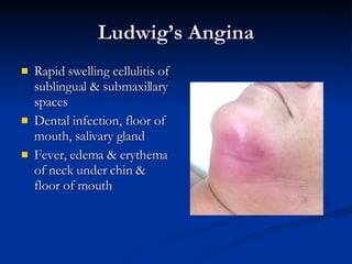 Ludwig’s Angina Rapid swelling cellulitis of sublingual & submaxillary spaces Dental infection, floor of mouth, salivary gland Fever, edema & erythema of neck under chin & floor of mouth 