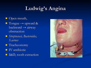 Ludwig’s Angina Open mouth,  Tongue  ->  upward & backward   ->   airway obstruction Streptococci, Bacteroides, S.aerues Tracheostomy IV antibiotic I&D, tooth extraction 