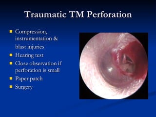 Traumatic TM Perforation Compression, instrumentation &  blast injuries Hearing test Close observation if perforation is small Paper patch Surgery 