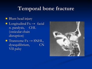 Temporal bone fracture Blunt head injury Longitudinal Fx  ->  facial n. paralysis,  CHL (ossicular chain disruption) Transverse Fx  ->  SNHL, dysequilibrium,  CN VII palsy 