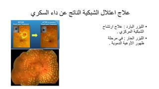 ‫السكري‬ ‫داء‬ ‫عن‬ ‫الناتج‬ ‫الشبكية‬ ‫اعتالل‬ ‫عالج‬
•‫البارد‬ ‫الليزر‬:‫ارتشاح‬ ‫عالج‬
‫المركزي‬ ‫الشبكية‬.
•‫الحار‬ ‫الليزر‬:‫مرحلة‬ ‫في‬
‫الدموية‬ ‫األوعية‬ ‫ظهور‬.
 