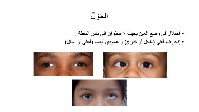 أمراض العيون الشائعة