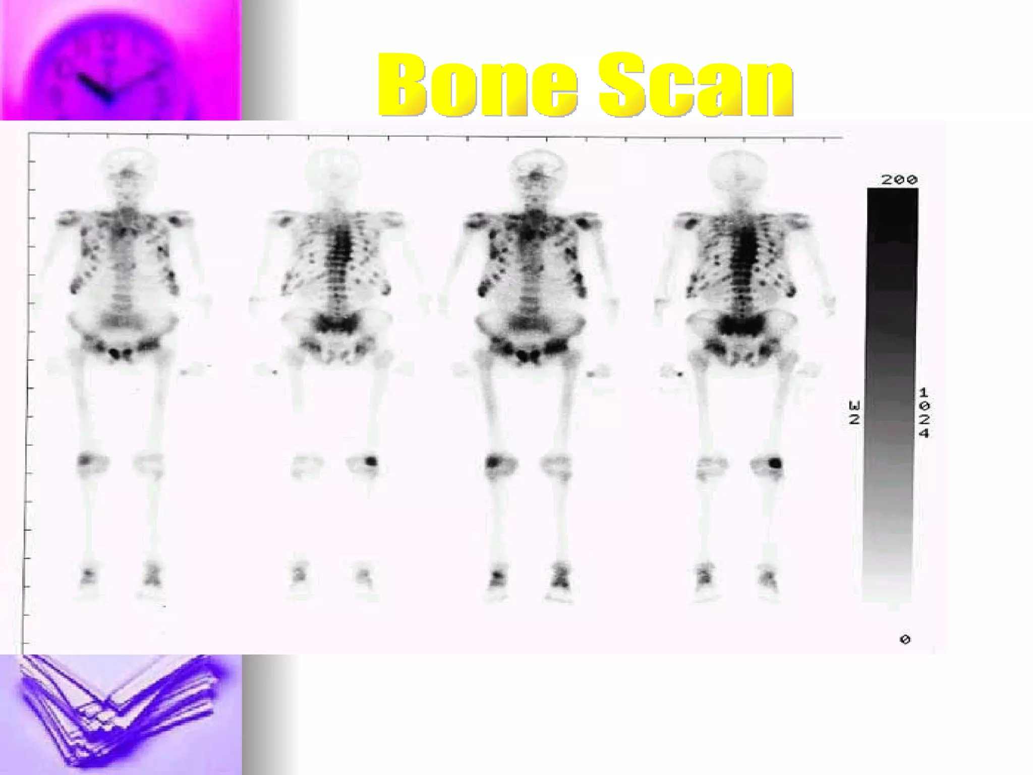 Bone Scan 