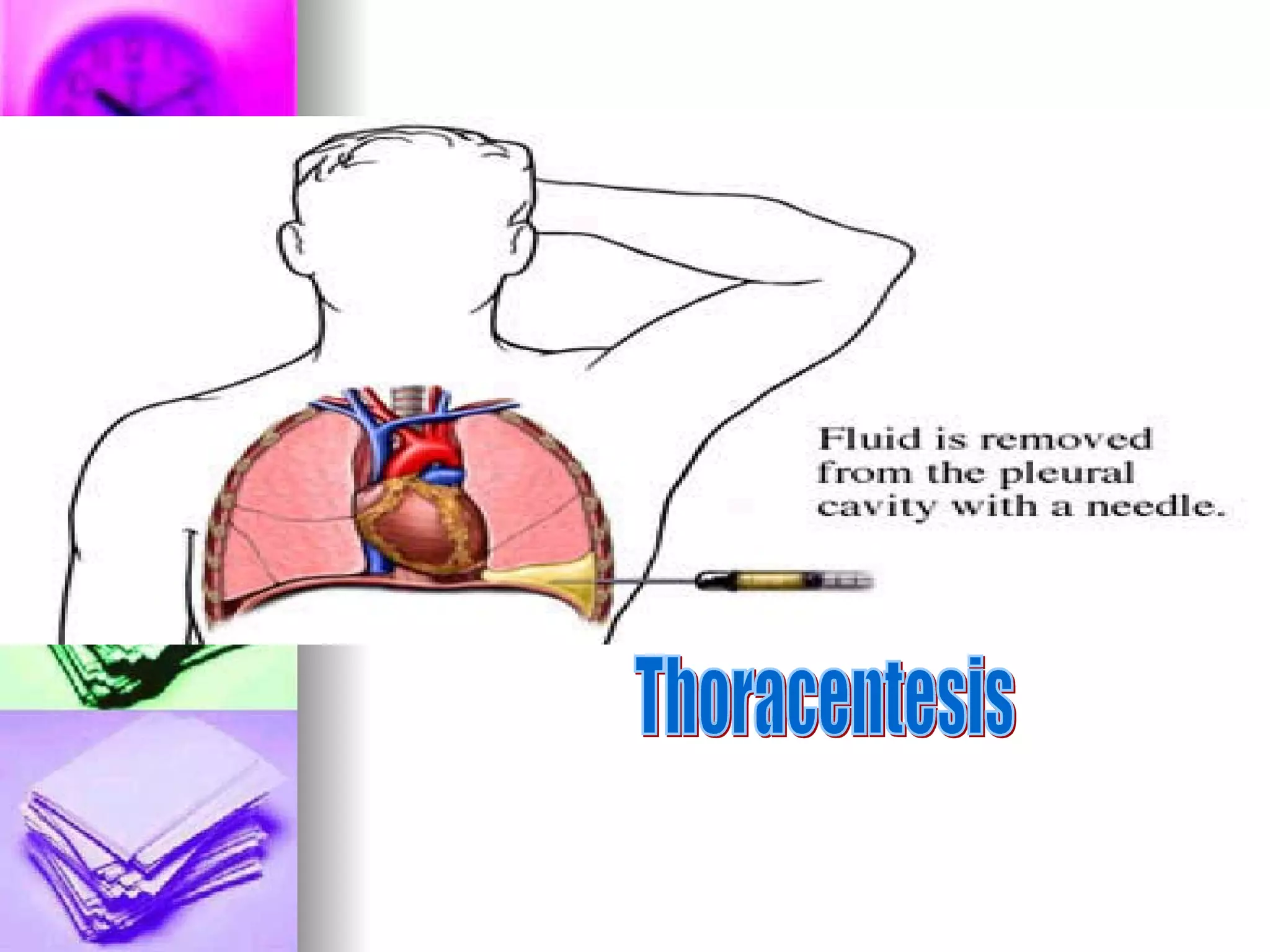 Thoracentesis 