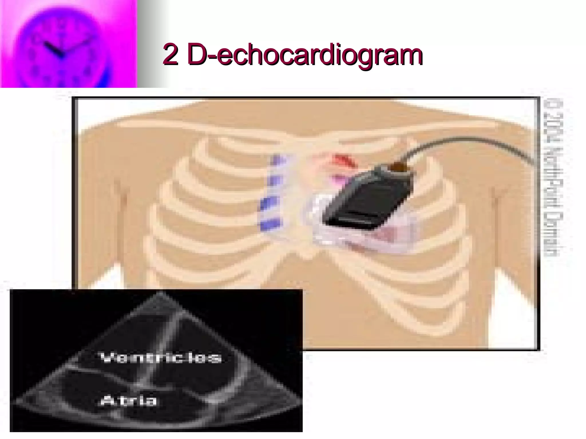 2 D-echocardiogram 